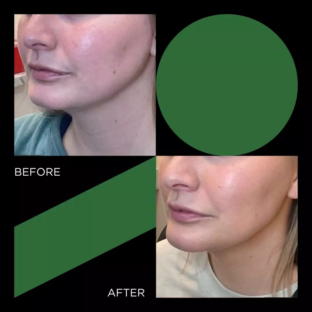 Before and After FINETUNE MedSpa In Frisco Texas