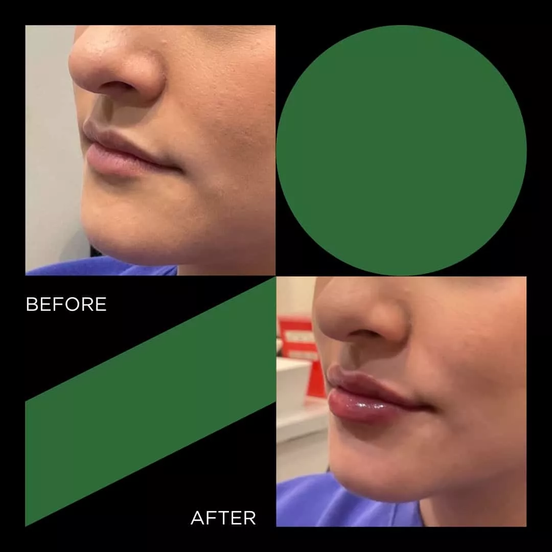 Before and After botox filler FINETUNE MedSpa In Frisco Texas