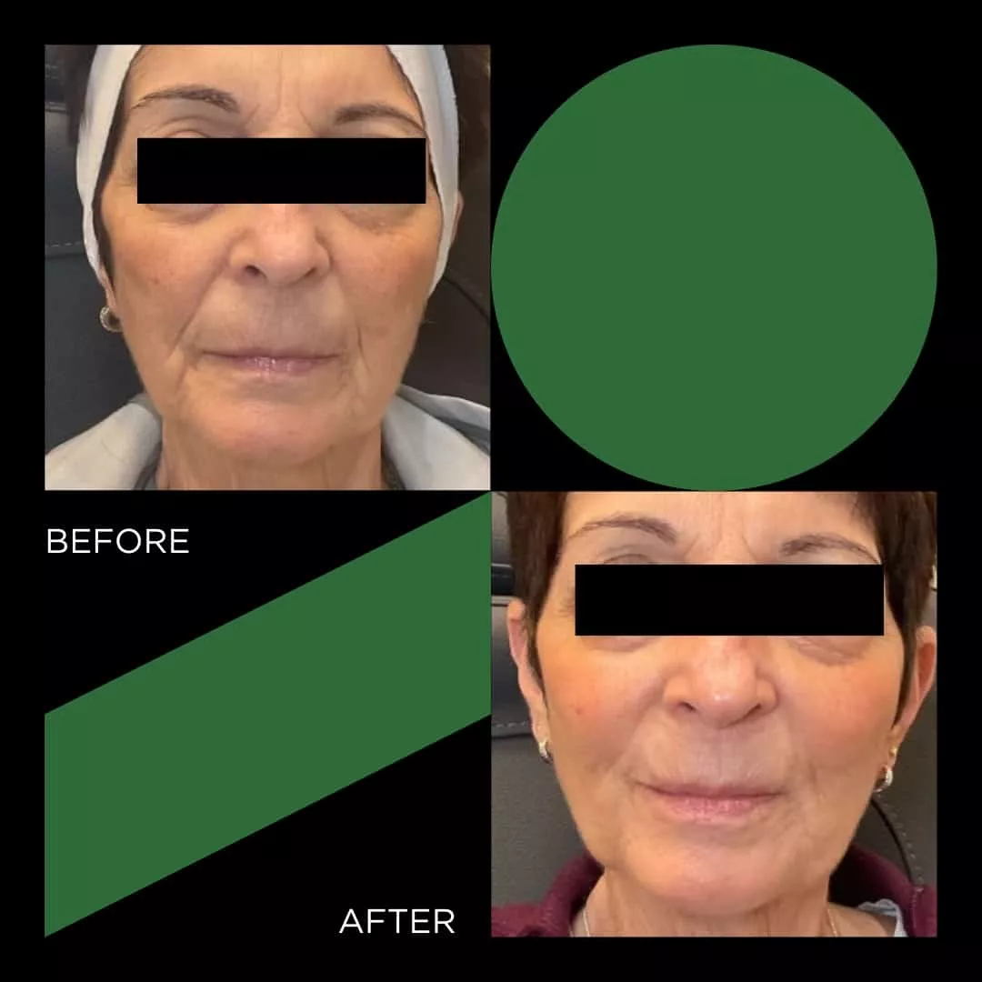 Before and After facelift FINETUNE MedSpa In Frisco Texas