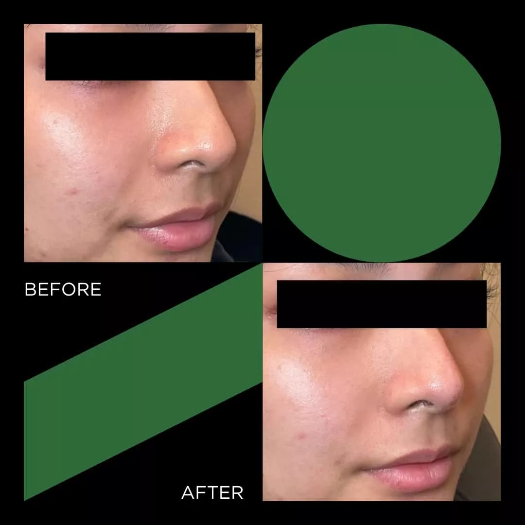 Before and After filler FINETUNE MedSpa In Frisco Texas