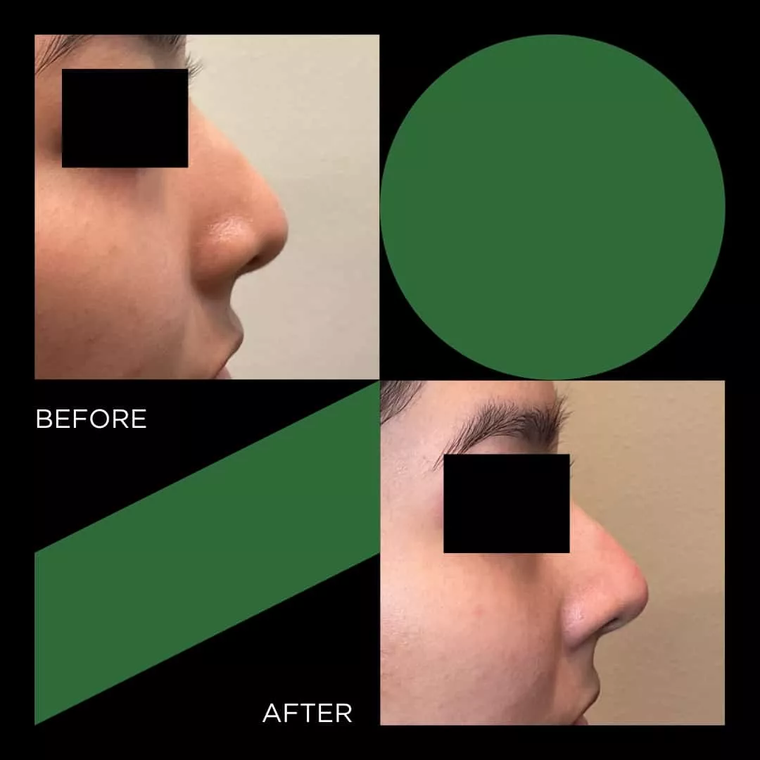Before and After lip FINETUNE MedSpa In Frisco Texas